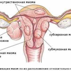 Рак на матката: фаза, симптоми, третман, дијагноза