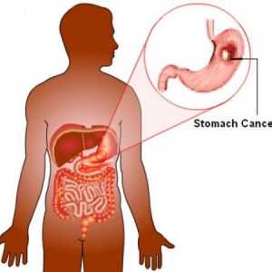 Рак на желудникот: патогенезата, хистологија, колку долго