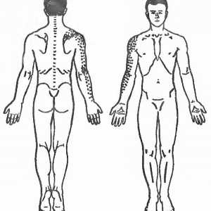 Истегнување на мускулите на рацете со болки во грбот