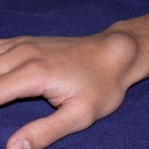 Сарком на меки ткива кои на подрачјето на раката и зглобовите: причини, третман