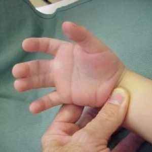 Syndactyly на прстите: Причини, симптоми, третманот, симптомите