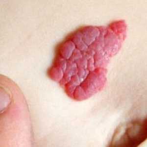 Синдром атипични birthmark (атипична мол синдром)