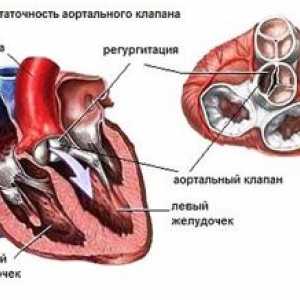 Синдроми, срцева слабост, и васкуларни