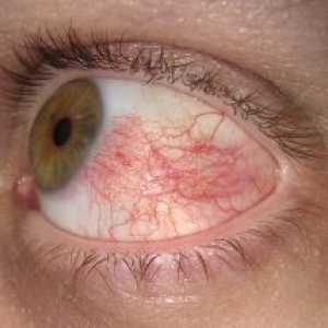Склеритис око: третман, симптомите, причините, симптомите