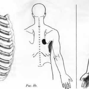 Болки во грбот предизвикани од serratus предниот мускул
