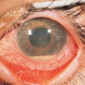 Токсоплазмоза retinohorioidit