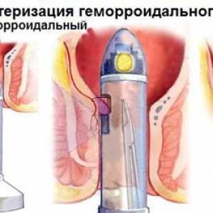Transanal dezarterizatsiya внатрешни хемороиди