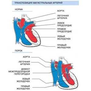 Транспозиција на големите артерии: предизвикува, хирургија, третман, симптоми, знаци
