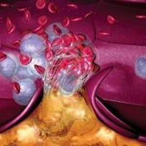 Тромбоза и пулмонална емболија