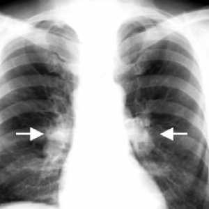 Туберкулоза на интраторакални лимфни јазли: третман, компликации, причините, симптомите