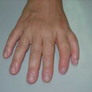 Удвојување на првиот прст (или зрак preaxial полидактилија)