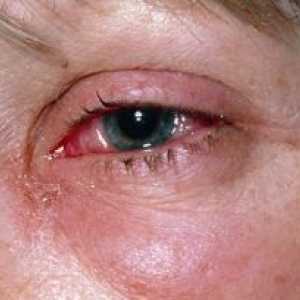 Модринки и повреди на очите: третман, прва помош, причини, симптоми, знаци