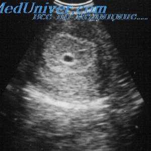 Ултразвук во првиот триместар од бременоста. Индикации за transvaginal ултразвук во првиот…