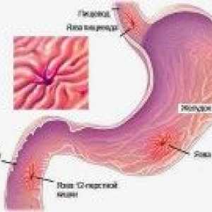 Видови на чир на желудникот: разновидноста и опис