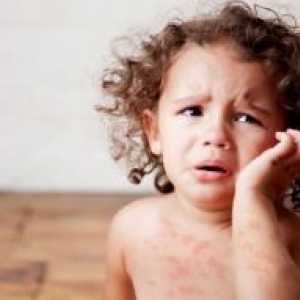 Вирусни заболувања кај децата, придружени со осип