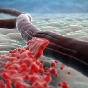 Интрацеребрална хеморагија кај недоносените: импликации, третман, прогнозата