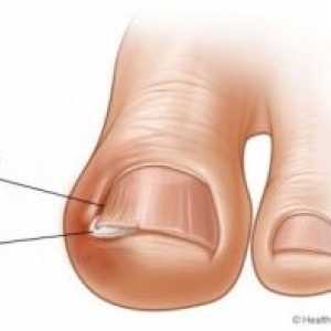 Вродените ноктите на нозете: третман, причини, симптоми, знаци