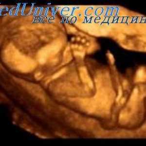 Конгенитална ампутација на фетусот. Синдром aglossia-adactylia