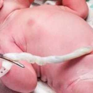 Пролапс на папочната врвца по раѓањето: ефектите, причините