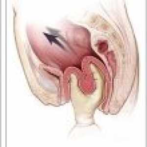 Еверзија на грлото на матката за време на породувањето: третман, причини, симптоми, ефекти
