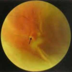 Заболувања на периферијата на мрежницата: rhegmatogenous ретинална аблација. Епидемиологија и…
