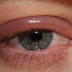 Болести на векот човечкото око: третман, превенција, знаци, симптоми, причини