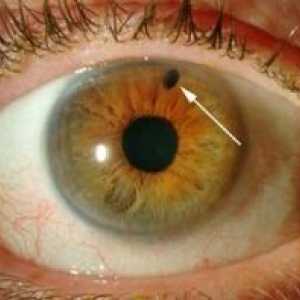 Агол-затворање глауком: третман, симптомите, причините, симптомите