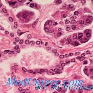 Малигните insuloma. Морфологијата на тумори Лангерхансови островчиња