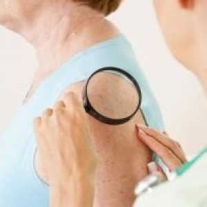 Малигните тумори на кожата: класификација